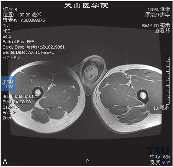 图A：CT，睾丸精原细胞瘤，男，22岁，右侧睾丸占位，右侧睾丸见一结节状T2WI压脂等信号灶，边缘清晰，内部信号不均匀，DWI呈高信号，T1WI增强病变可见强化