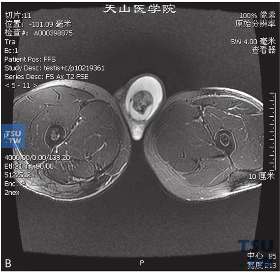 图B：CT，睾丸精原细胞瘤，男，22岁，右侧睾丸占位，右侧睾丸见一结节状T2WI压脂等信号灶，边缘清晰，内部信号不均匀，DWI呈高信号，T1WI增强病变可见强化