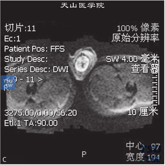 图B：CT，睾丸精原细胞瘤，男，22岁，右侧睾丸占位，右侧睾丸见一结节状T2WI压脂等信号灶，边缘清晰，内部信号不均匀，DWI呈高信号，T1WI增强病变可见强化