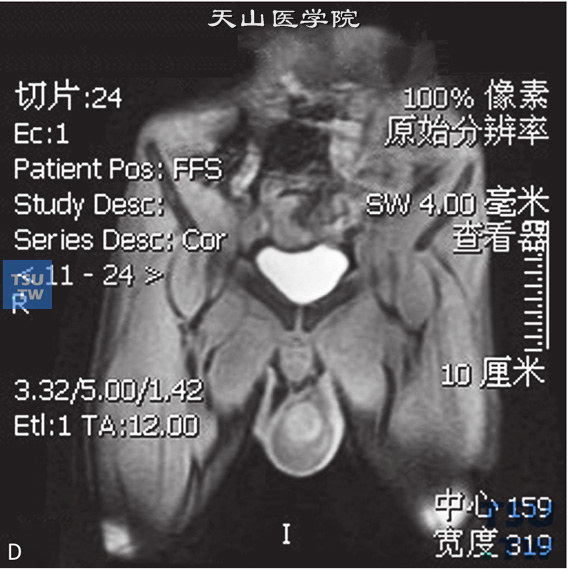 图D：CT，睾丸精原细胞瘤，男，22岁，右侧睾丸占位，右侧睾丸见一结节状T2WI压脂等信号灶，边缘清晰，内部信号不均匀，DWI呈高信号，T1WI增强病变可见强化