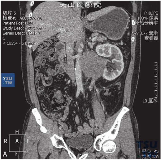 图A：CT，精原细胞瘤，男，55岁，发现腹膜后肿物2周。腹膜后见团状软组织密度灶，包绕左肾动静脉，并累及左侧腰大肌及腹主动脉