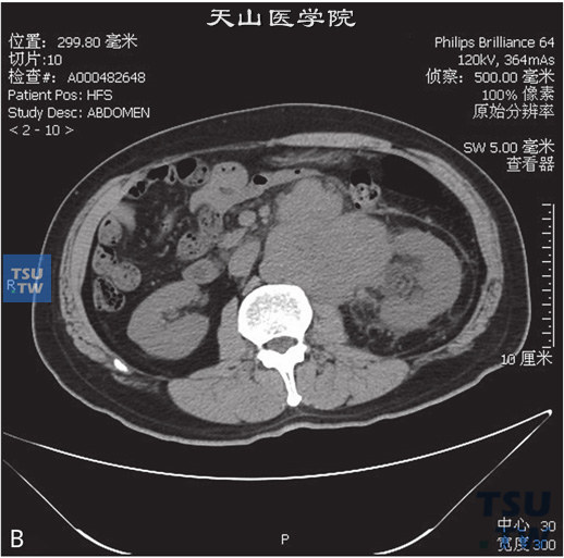 图B：CT，精原细胞瘤，男，55岁，发现腹膜后肿物2周。腹膜后见团状软组织密度灶，包绕左肾动静脉，并累及左侧腰大肌及腹主动脉