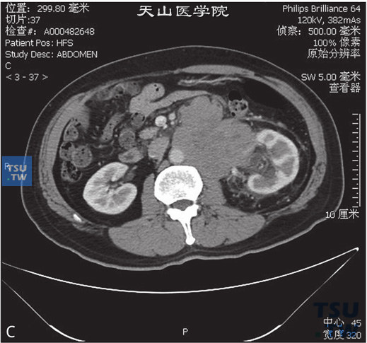 图C：CT，精原细胞瘤，男，55岁，发现腹膜后肿物2周。腹膜后见团状软组织密度灶，包绕左肾动静脉，并累及左侧腰大肌及腹主动脉