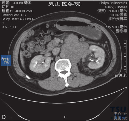 图D：CT，精原细胞瘤，男，55岁，发现腹膜后肿物2周。腹膜后见团状软组织密度灶，包绕左肾动静脉，并累及左侧腰大肌及腹主动脉