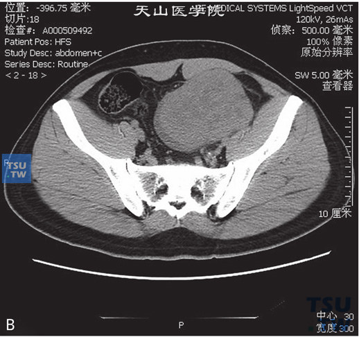 图B：CT-隐睾恶变，精原细胞瘤。男，36岁，隐睾，腹痛待查。盆腔内见不均匀软组织密度灶，边缘清晰，内部散在小片状低密度灶。增强后病灶中等强化，冠状位重建可见与病灶相连的鞘突，部分位于腹股沟管内