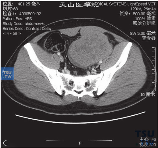 图C：CT-隐睾恶变，精原细胞瘤。男，36岁，隐睾，腹痛待查。盆腔内见不均匀软组织密度灶，边缘清晰，内部散在小片状低密度灶。增强后病灶中等强化，冠状位重建可见与病灶相连的鞘突，部分位于腹股沟管内