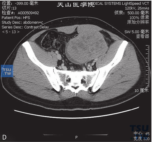 图B：CT-隐睾恶变，精原细胞瘤。男，36岁，隐睾，腹痛待查。盆腔内见不均匀软组织密度灶，边缘清晰，内部散在小片状低密度灶。增强后病灶中等强化，冠状位重建可见与病灶相连的鞘突，部分位于腹股沟管内