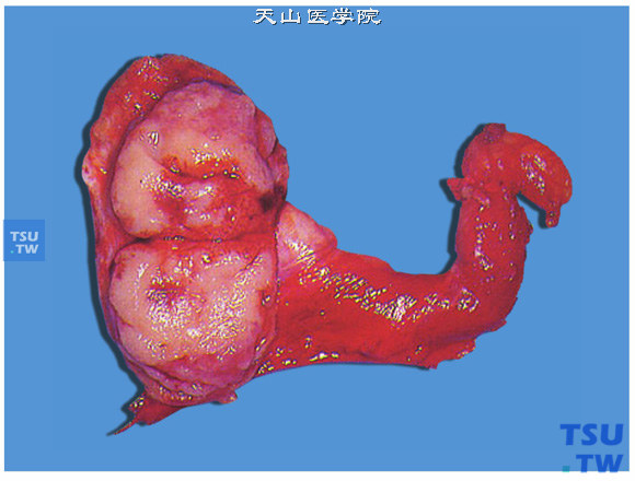 睾丸精原细胞瘤（切面）。肿瘤淡黄色，切面凸出于周围的睾丸实质