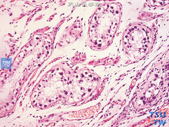 睾丸肿瘤旁的曲细精管内生殖细胞肿瘤，未分类型（IGCNU）。示胞质透明，核大，不规则，染色质粗