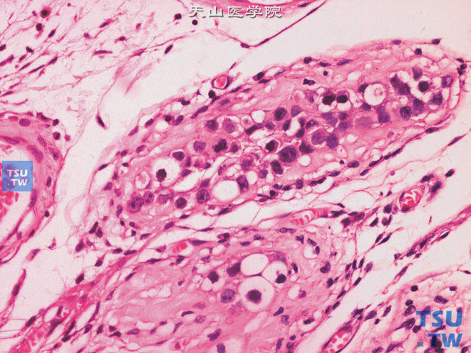 睾丸肿瘤旁的曲细精管内生殖细胞肿瘤，未分类型（IGCNU）。高倍镜下示IGCNU细胞特点及核分裂象