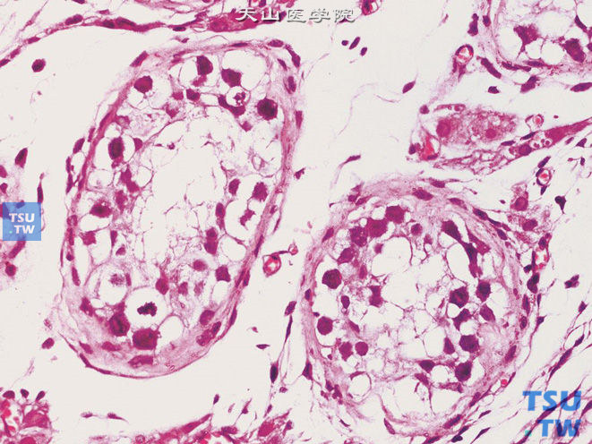 睾丸肿瘤旁的曲细精管内生殖细胞肿瘤，未分类型（IGCNU）。高倍镜下示核分裂象