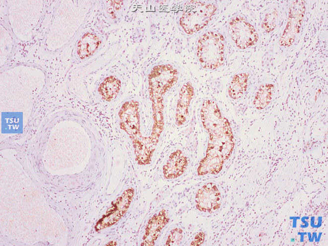 睾丸肿瘤旁的曲细精管内生殖细胞肿瘤，未分类型（IGCNU）。免疫组化PLAP（+）