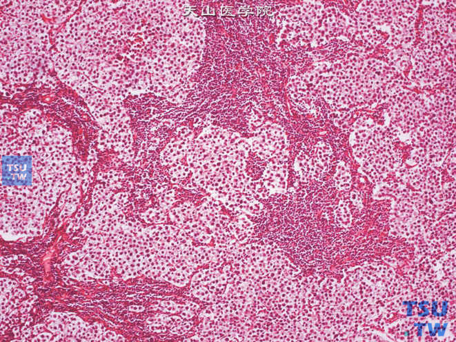 睾丸精原细胞瘤，一致的肿瘤细胞被纤细的纤维分隔成片状，伴淋巴细胞浸润