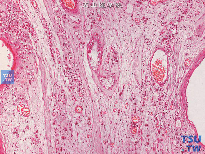 精原细胞瘤，示肿瘤细胞于睾丸间质中浸润性生长，可见残存的曲细精管