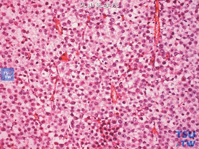 精原细胞瘤，上图高倍，瘤细胞胞膜清晰，胞质透明。可见明显核仁