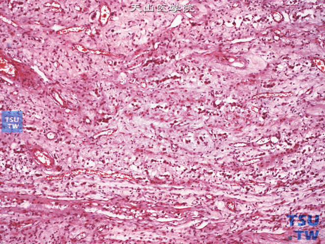 精原细胞瘤，示肿瘤细胞排列成条索状