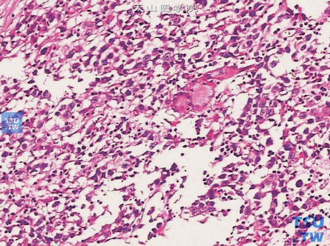 精原细胞瘤，伴肉芽肿反应，示多核巨细胞