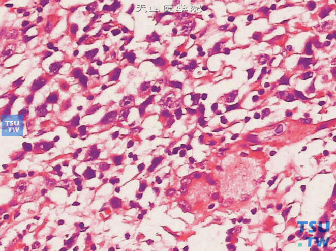 精原细胞瘤，伴肉芽肿反应，示多核巨细胞，上图高倍