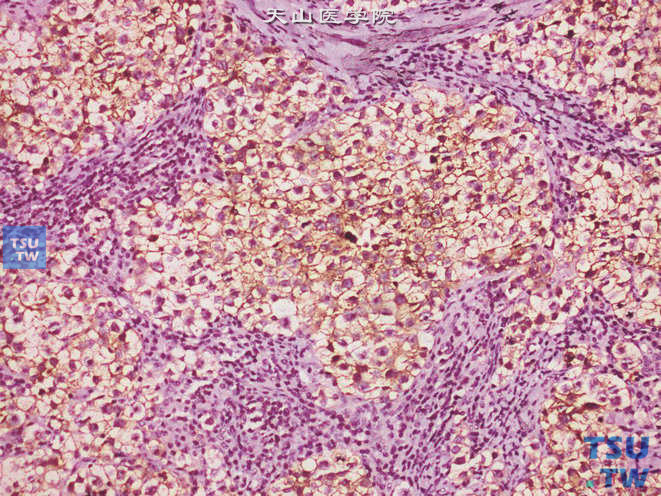睾丸经典精原细胞瘤，PLAP（+）