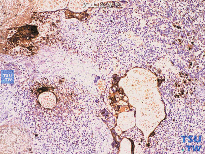 精原细胞瘤伴合体滋养叶细胞。免疫组化：HCG（+），上图高倍