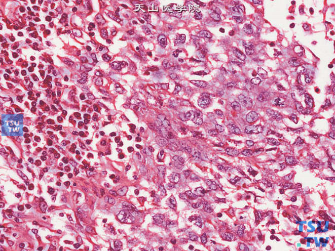 间变型精原细胞瘤，示核异型明显，核分裂象多见