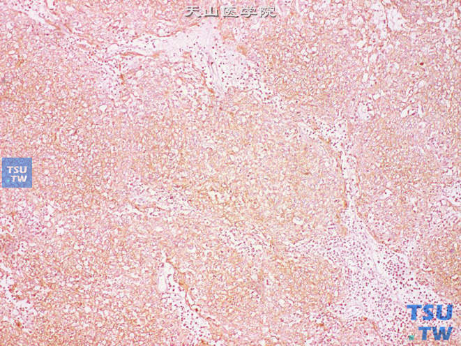 间变型精原细胞瘤，免疫组化：PLAP（+）