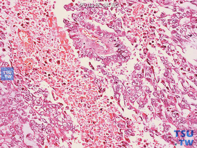 睾丸胚胎性癌，肿瘤呈乳头状结构，伴坏死