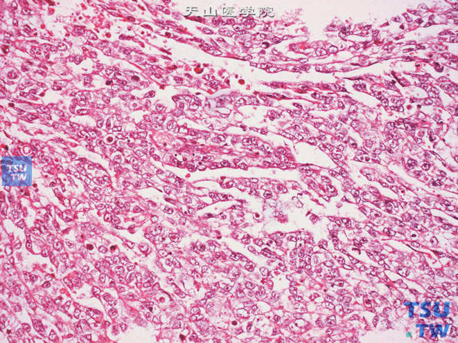 睾丸胚胎性癌，示肿瘤呈裂隙状结构，具有显著的泡状核与清晰的核仁