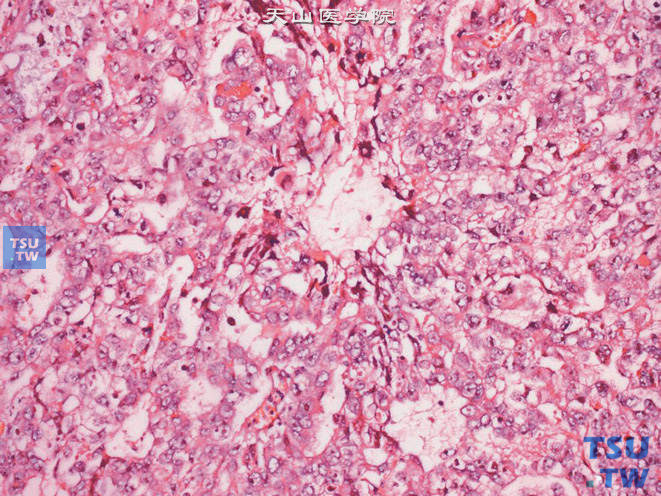 睾丸胚胎性癌，示肿瘤巢片周边的细胞退变或凋亡