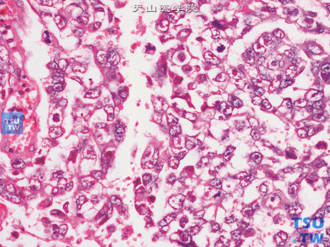 睾丸胚胎性癌，示细胞核呈泡状，核膜清晰。可见一个或多个显著核仁。核分裂象易见