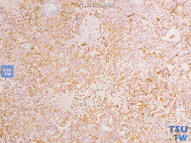 睾丸胚胎性癌，免疫组化：广谱CK（+）