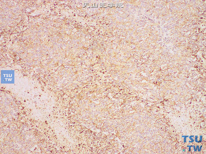 睾丸胚胎性癌，免疫组化：PLAP（+）