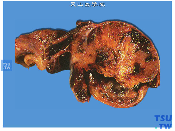 睾丸卵黄囊瘤，实性、灰白色或棕色。可有出血、囊性变和黏液变性