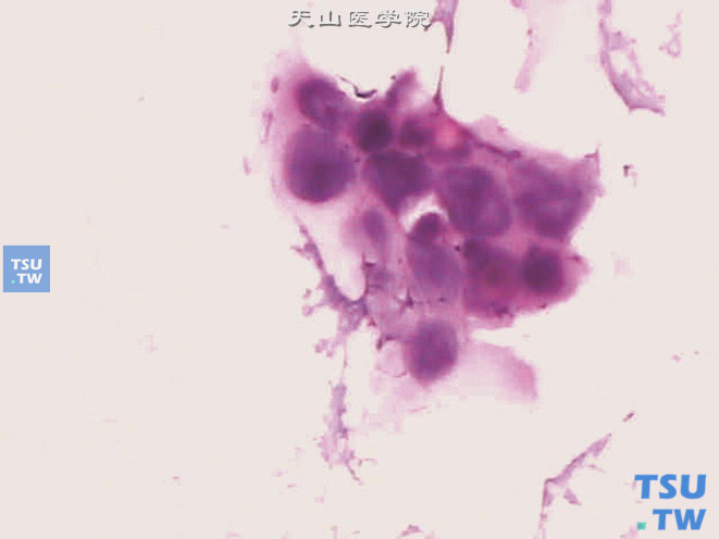 卵黄囊瘤-细胞印片