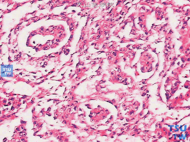 睾丸卵黄囊瘤，内胚窦型。可见Schiller-Duval小体，或称肾小球样小体