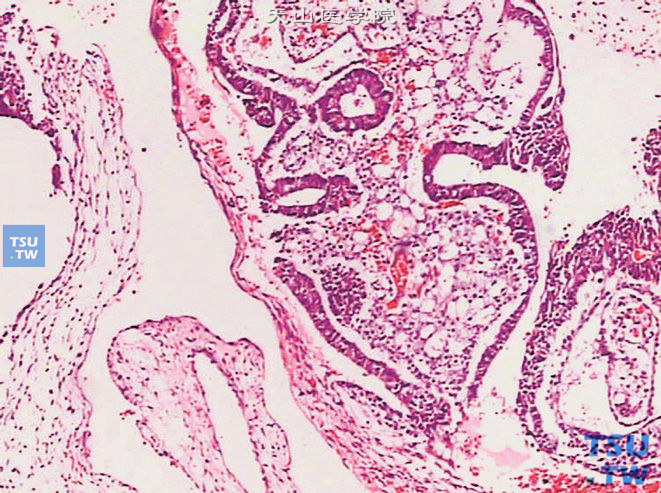 卵黄囊瘤，内胚窦型。示Schiller-Duval小体