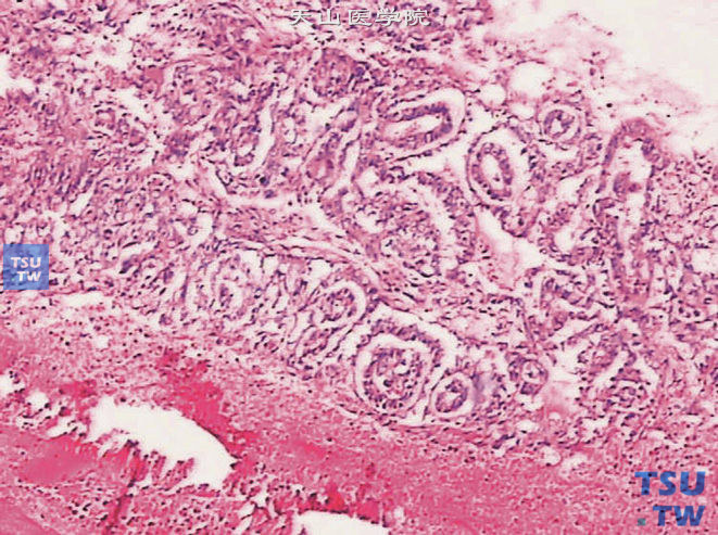 睾丸卵黄囊瘤，内胚窦型，可见坏死