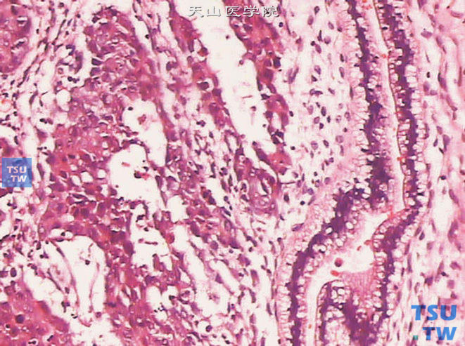 卵黄囊瘤，腺型（肠型）。可见肠样腺体。腺体细胞的基底部可见空泡变性