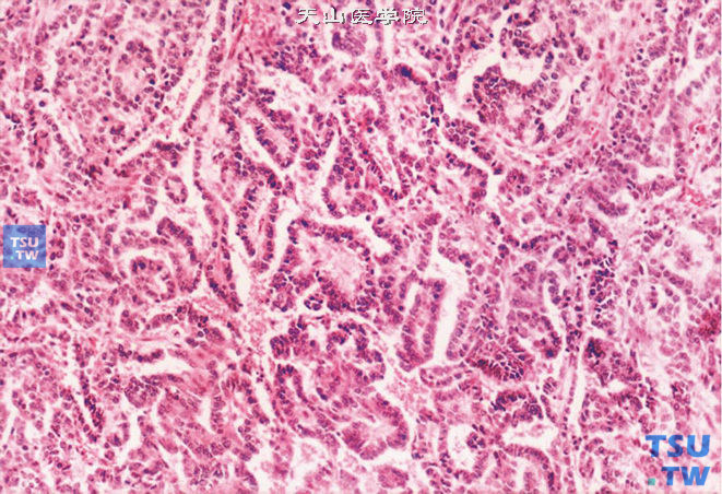 睾丸卵黄囊瘤，乳头型。可见乳头状结构。瘤细胞为立方或矮柱状