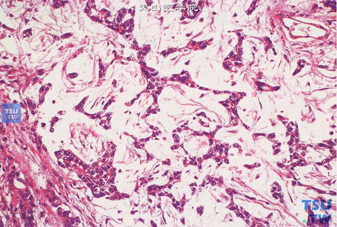 睾丸卵黄囊瘤，黏液型。可见黏液样基质。肿瘤细胞呈上皮样或梭形