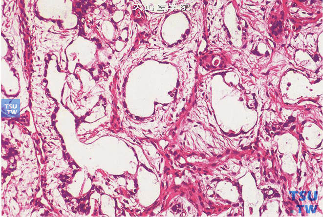 睾丸卵黄囊瘤，多囊型。囊样结构衬以扁平的、看似良性的上皮，伴有黏液性或纤维性间质