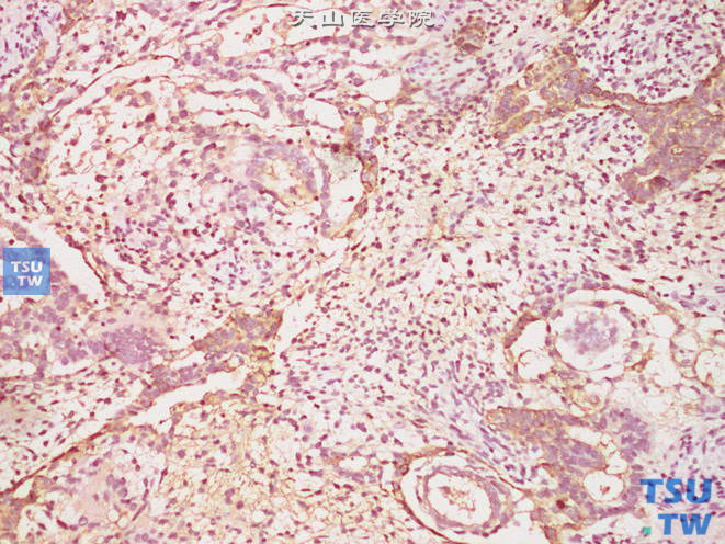 睾丸卵黄囊瘤，免疫组化：AFP（+）