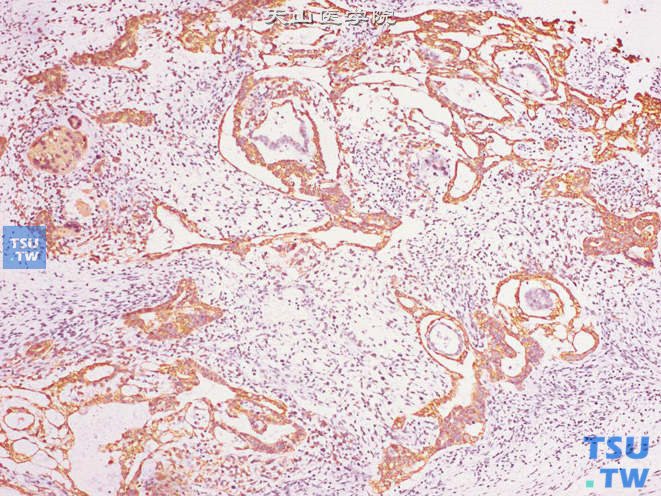 睾丸卵黄囊瘤，免疫组化：广谱CK（+）