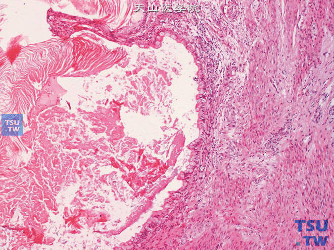 睾丸成熟性畸胎瘤，示同一囊腔被覆上皮可见成熟的鳞状上皮（图上方）伴角化及肠上皮（图中下方），并见成熟肌组织（图右侧）