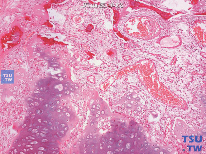 睾丸成熟性畸胎瘤，示成熟软骨及骨化成分