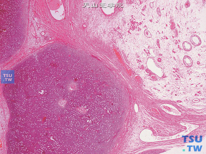 睾丸成熟性畸胎瘤，示成熟软骨成分及与睾丸组织交界处