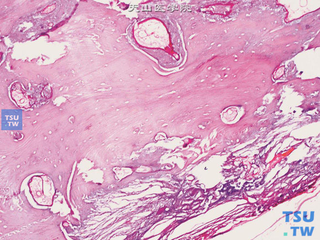 睾丸单胚层成熟性畸胎瘤中的骨组织