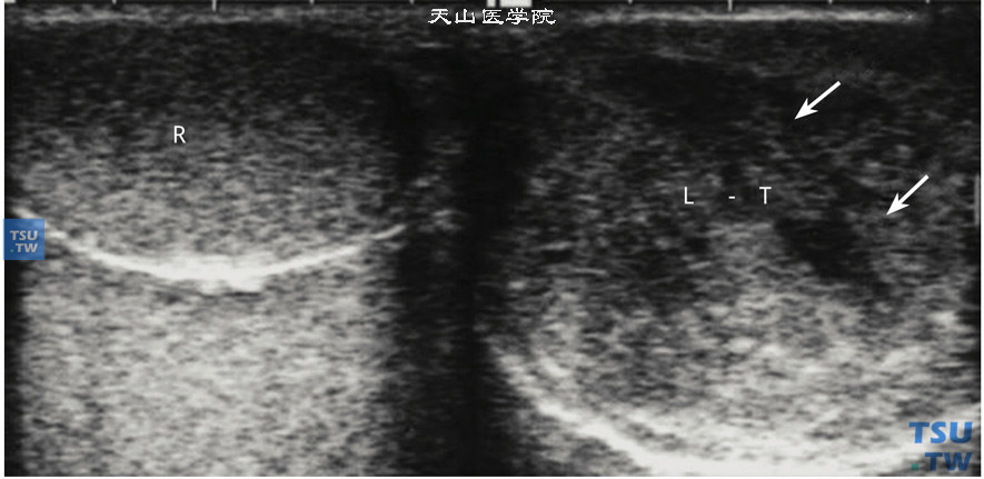 睾丸绒毛膜上皮癌超声图像特点：绒毛膜上皮癌恶性度较高，早期可出现血行转移。超声特点：睾丸体积增大，内部常因出血坏死表现多发片状低回声或无回声区，与残存的睾丸组织分界不清。右睾丸正常。左睾丸箭头指示出血坏死区