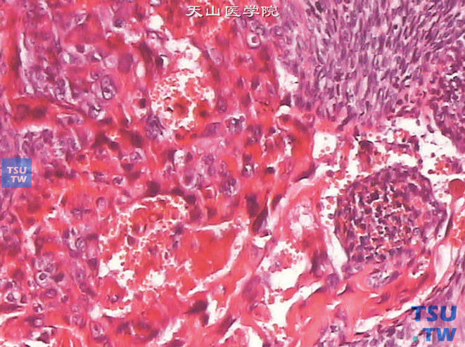 混合性生殖细胞肿瘤中的绒癌成分，示胞质嗜酸的合体滋养叶细胞及单核的胞质淡染或透明的滋养层细胞