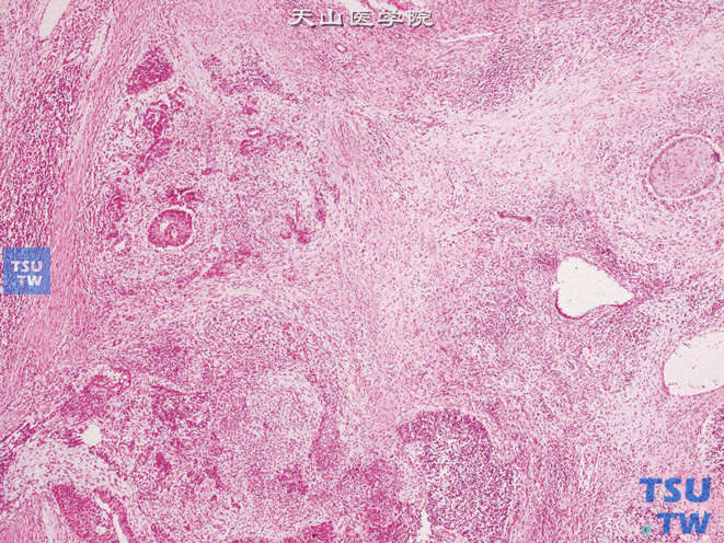 睾丸混合性生殖细胞肿瘤，畸胎瘤（中间偏右）+胚胎性癌（中间偏左）+精原细胞瘤（左侧边缘）
